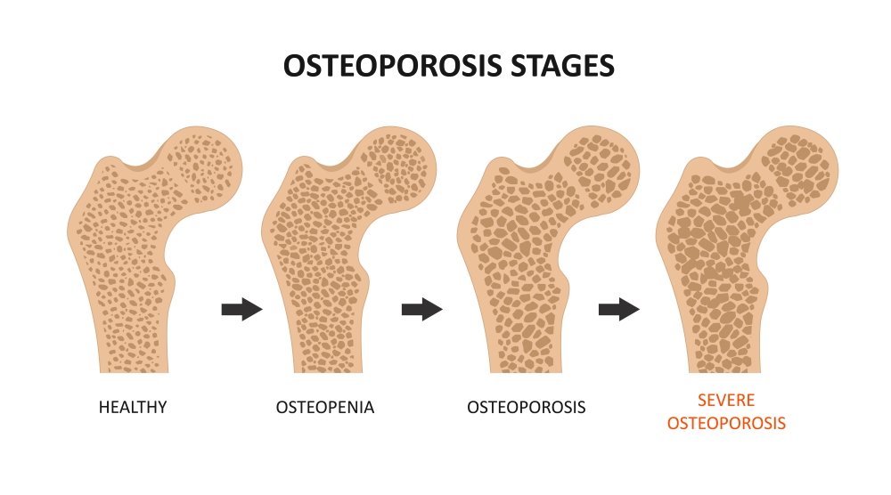 Osteoporosis stages